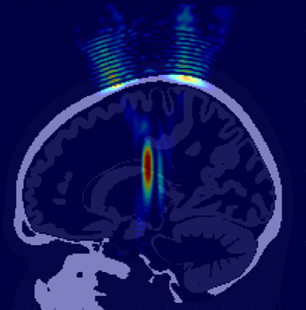 Transcranial focused ultrasound acoustic field simulation